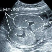 双肾小胎儿（胎儿有两个肾盂有影响吗）