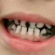 孕期牙齿黑（孕期牙齿黑是什么原因）