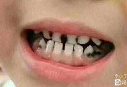 孕期牙齿黑（孕期牙齿黑是什么原因）