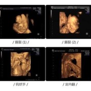 什么是大排畸,胎儿四维排畸什么时候做