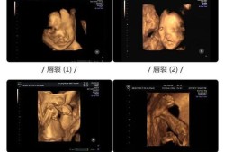 什么是大排畸,胎儿四维排畸什么时候做