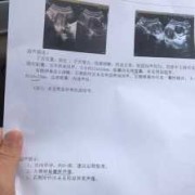 怀孕了有囊肿孩子能要吗,胎儿襄肿是怎么回事