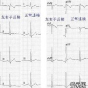 问什么是道岔的反位,胎儿心脏反位是什么情况