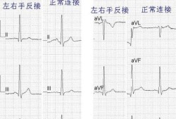 问什么是道岔的反位,胎儿心脏反位是什么情况