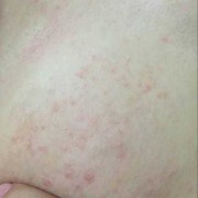 孕期胸部痒（孕期胸部痒是怎么回事）