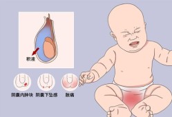 胎儿鞘膜积液（胎儿鞘膜积液是什么原因造成的）