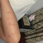 怀孕11周，胳膊、腿上身上长了好多湿疹，痒的受不了，有什么,孕期脸上长湿疹怎么办啊