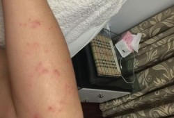 怀孕11周，胳膊、腿上身上长了好多湿疹，痒的受不了，有什么,孕期脸上长湿疹怎么办啊