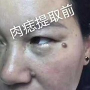 孕期脸上长疣（孕期脸上长疣怎么办）