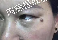 孕期脸上长疣（孕期脸上长疣怎么办）
