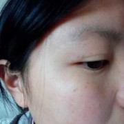 怀孕期间脸上长斑有什么好的办法可以除去或者淡化吗,怀孕期间长斑如何消除最快