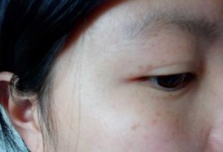 怀孕期间脸上长斑有什么好的办法可以除去或者淡化吗,怀孕期间长斑如何消除最快