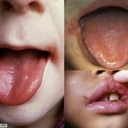 孕妇烂嘴角对胎儿影响（孕妇烂嘴角对胎儿影响大吗）