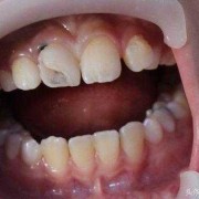 孕期能看牙医吗（孕妇牙洞疼烂到神经了怎么办）
