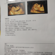 孕期没做nt（孕期没做nt检查怎么办）