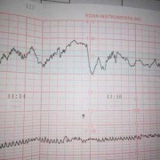 孕8周胎儿有多大（怀孕8周胎心监测仪每分钟100次左右正常不）