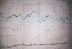 孕8周胎儿有多大（怀孕8周胎心监测仪每分钟100次左右正常不）