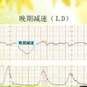 胎心监测时宝宝不动怎么办,胎心监护胎儿不动怎么办吸氧也不动