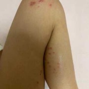 孕期腿上长疙瘩是胎毒（孕期腿上长疙瘩是胎毒图片）