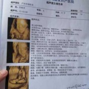 胎儿大排畸检查（大排畸多少周可以做）