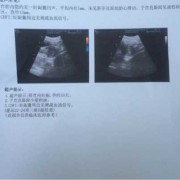 孕期照彩超（孕期照彩超多了好不好）