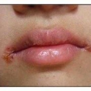 怀孕期间嘴角长疱疹（怀孕期间嘴角长疱疹了怎么办）