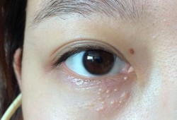 眼睛周围长脂肪粒原因,孕期脂肪粒越来越多