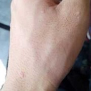 手背上长斑是什么原因,孕期手背长斑怎么回事