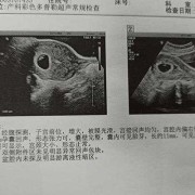 医生说胎儿头大（医生说胎儿头大是暗示男孩还是女孩）