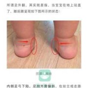 胎儿足外翻（宝宝的脚有点足外翻，去医院看应该看那个科）