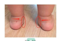 胎儿足外翻（宝宝的脚有点足外翻，去医院看应该看那个科）