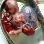 怀孕6周该如何做人流,怀孕期间流产有什么症状