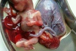怀孕6周该如何做人流,怀孕期间流产有什么症状