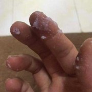 孕妇白带太多怎么办,孕晚期用手抠出一大坨豆腐渣