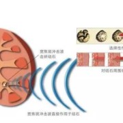 孕期碎石（孕期碎石对胎儿有影响吗）