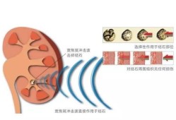 孕期碎石（孕期碎石对胎儿有影响吗）