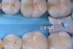 孕妇能补牙齿吗,孕期能不能补牙洞