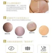怀孕期间妊娠纹怎么消除,孕期妊娠纹怎么预防增生