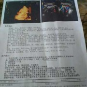 胎儿肠管畸形（26周胎儿局部肠管回声稍增强是怎么回事）