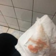 尿路感染有血很严重吗，尿路感染出血怎么回事,孕期尿路感染出血对胎儿有影响吗