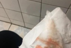 尿路感染有血很严重吗，尿路感染出血怎么回事,孕期尿路感染出血对胎儿有影响吗