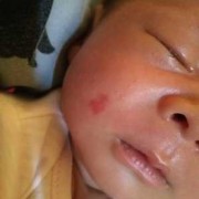 胎儿胎记是什么原因造成,胎儿长胎记的原因有哪些呢?