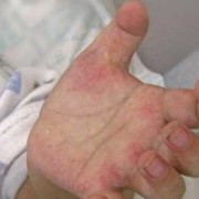孕期白血病（孕期白血病有什么症状）