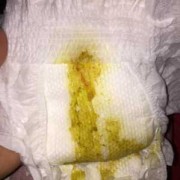 怀孕37周大便带血对胎儿有影响吗,孕妇大便出血要检查吗