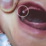 四个月宝宝长牙有什么症状,四个月胎儿样子图片