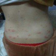 孕期湿疹怎么办（妊娠痒疹应该怎么治疗）