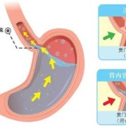 孕期胃食管反流（孕期胃食管反流怎么缓解）
