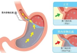 孕期胃食管反流（孕期胃食管反流怎么缓解）