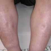 孕期会浮肿吗（我想知道大家怀孕有没有双腿浮肿的。都是从几个月开始的）