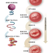 孕期怎么确定宫腔感染（宫腔内感染怎么治疗）